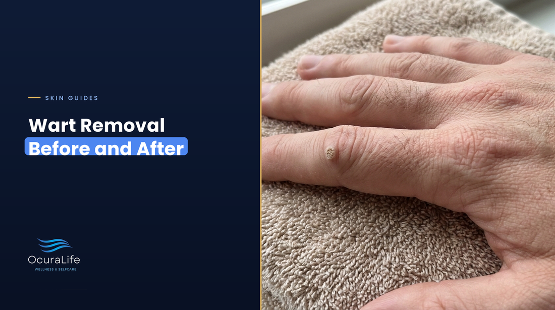Wart removal before and after: a common wart on a finger knuckle