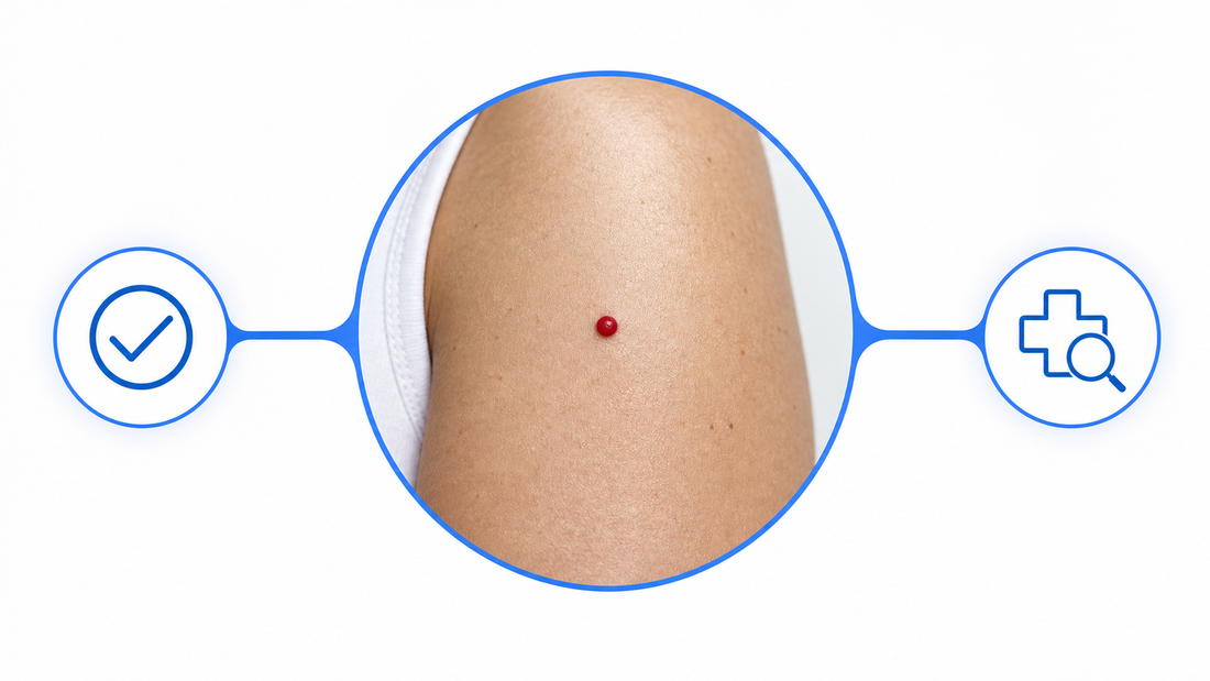 When a Cherry Angioma Is Worth a Doctor's Look, and When to Just Remove It infographic