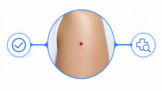 When a Cherry Angioma Is Worth a Doctor's Look, and When to Just Remove It infographic