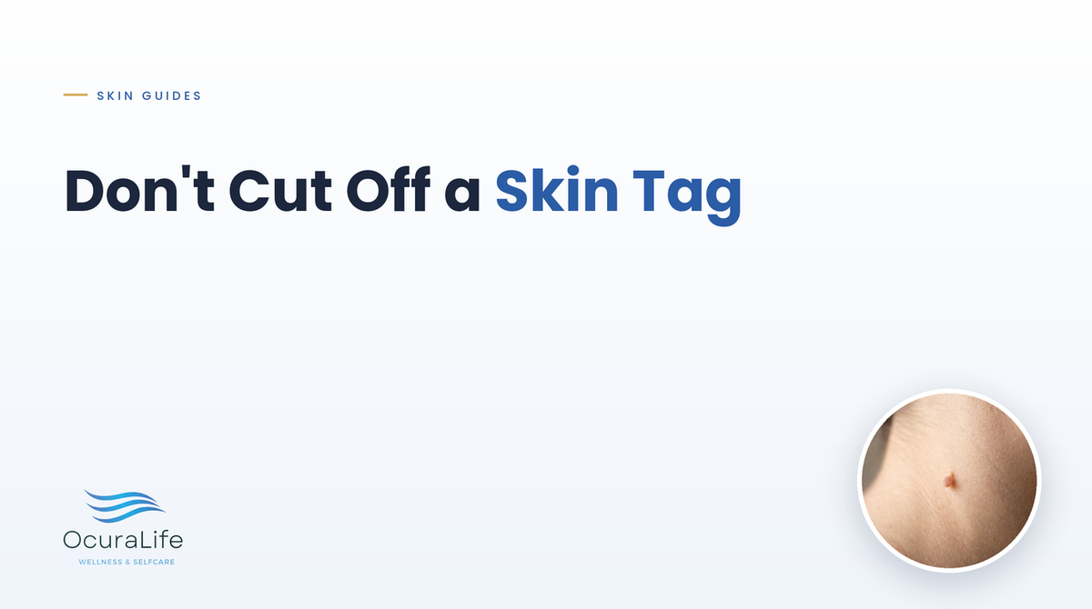 Why You Should Not Cut Off a Skin Tag