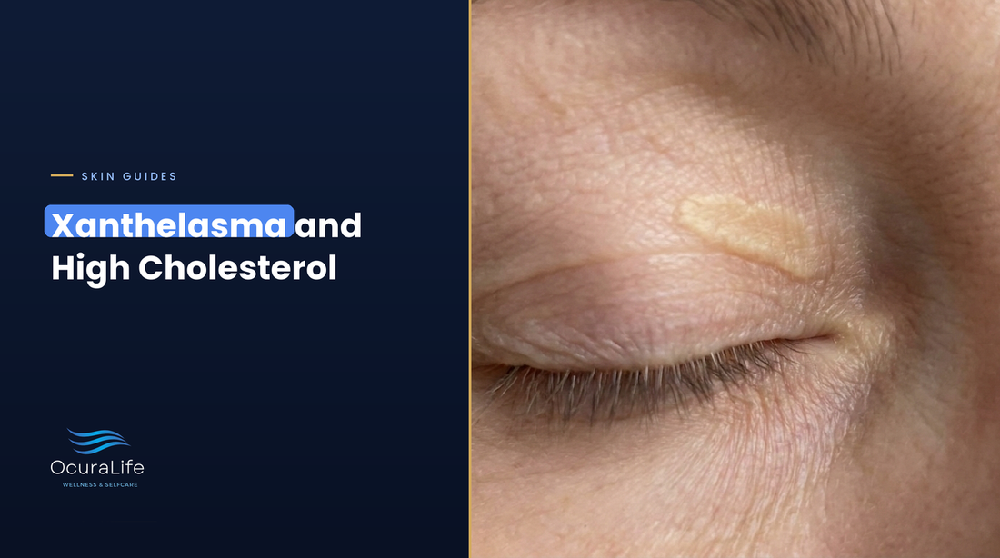 Xanthelasma plaque on the upper eyelid, a flat yellow cholesterol deposit