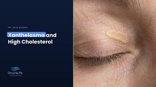 Xanthelasma plaque on the upper eyelid, a flat yellow cholesterol deposit