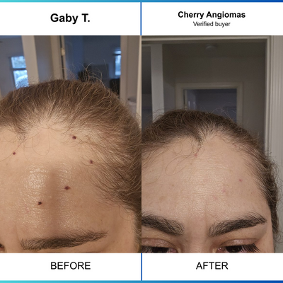 Cherry Angioma