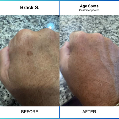Age Spot