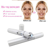 Blue Light Acne Remover Pen