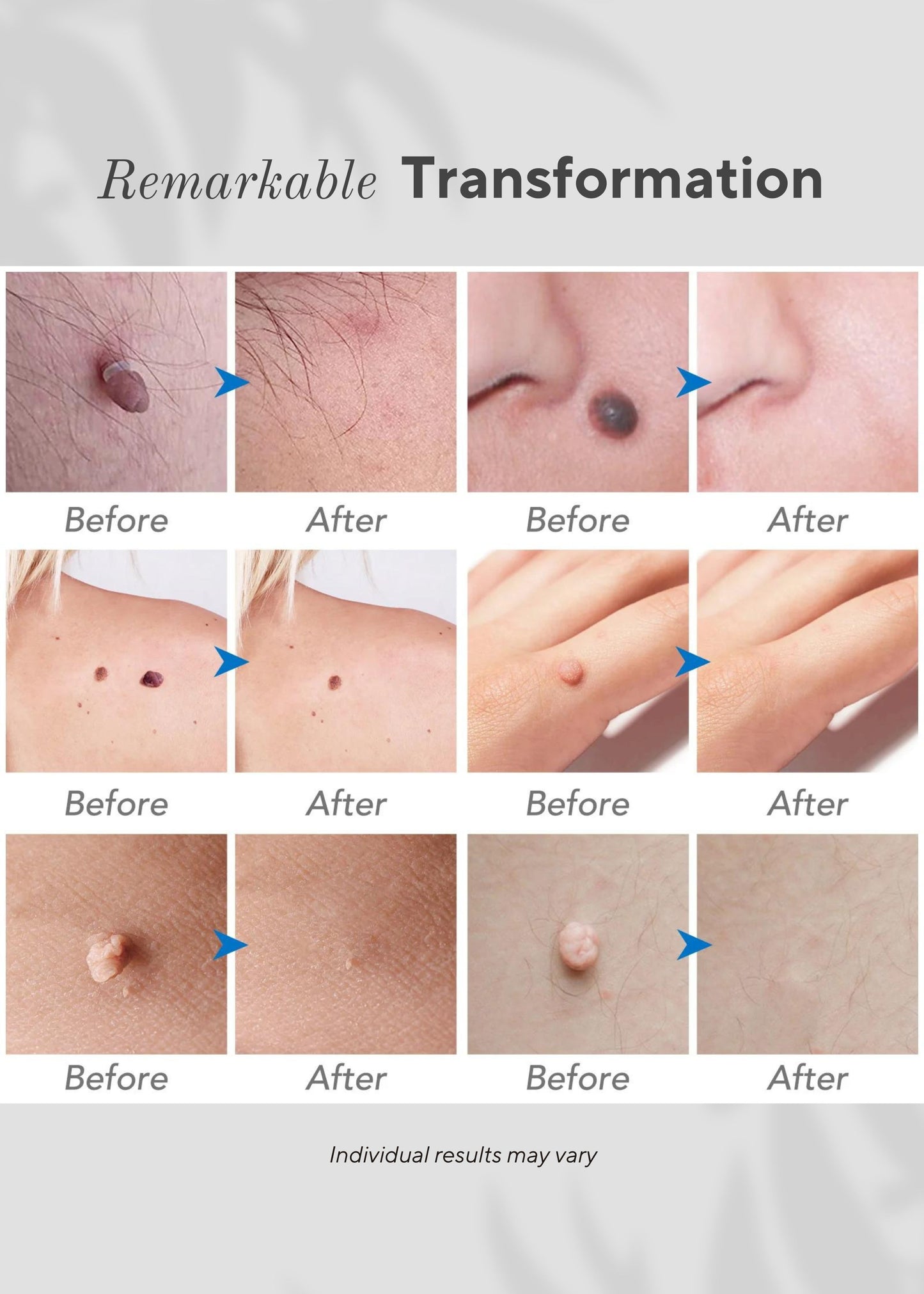 6-in-1 Skin Imperfection Removal Pen
