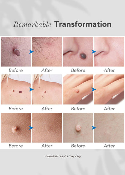 6-in-1 Skin Imperfection Removal Pen