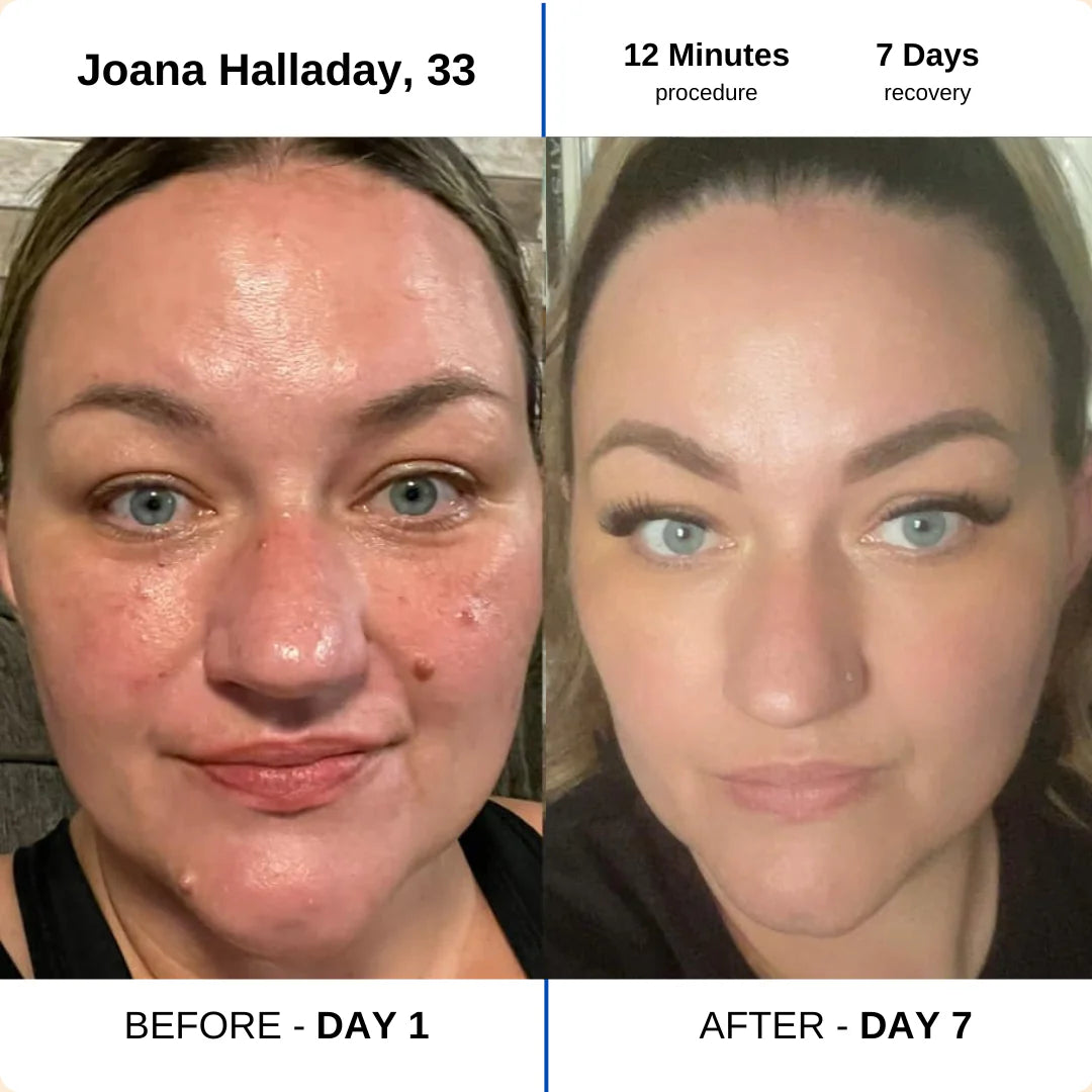 Joana, 33, facial blemishes before and after