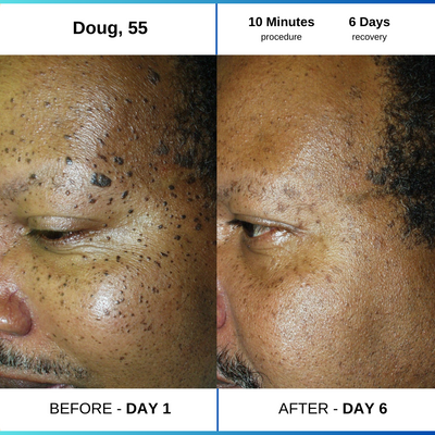 Seborrheic keratoses