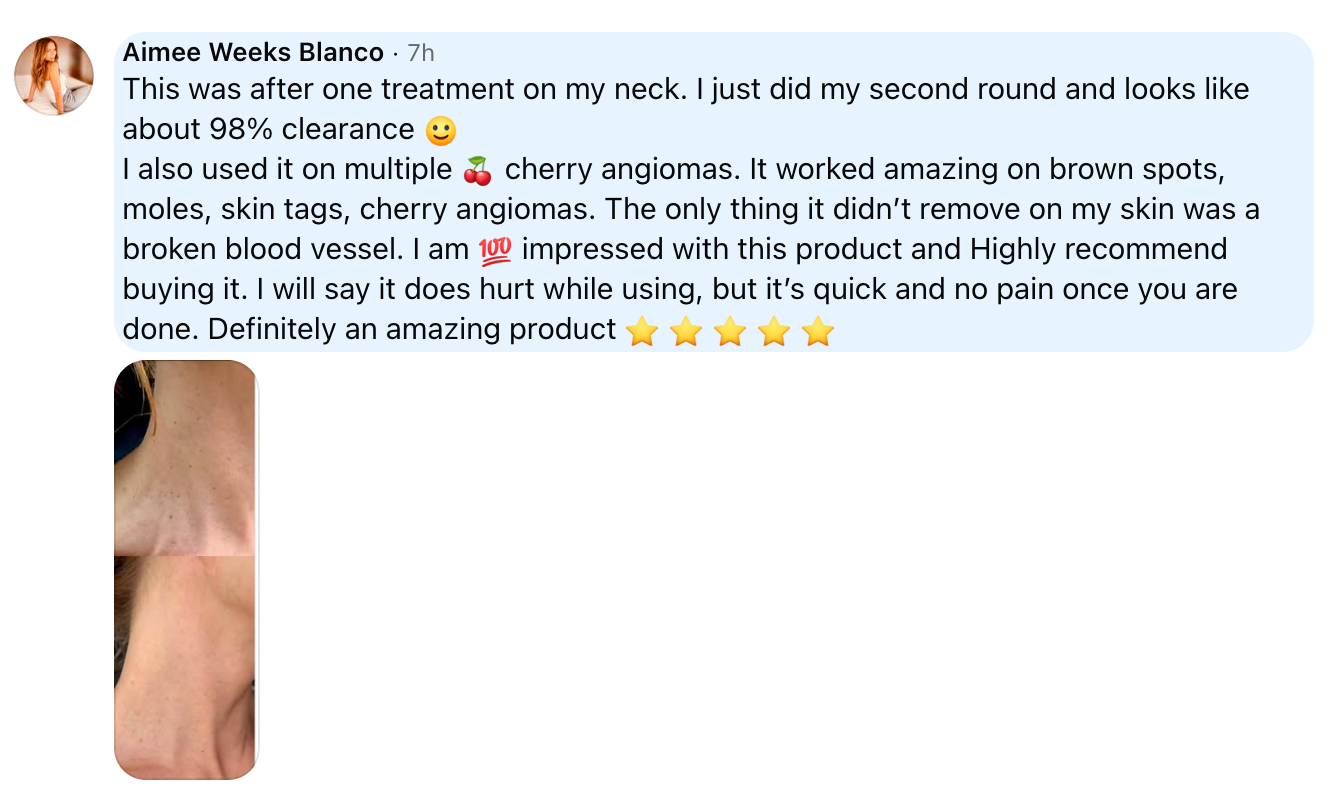 Aimee Weeks Blanco, Facebook comment with before and after neck photos: after two rounds about 98% clearance, also used on cherry angiomas, brown spots, moles and skin tags