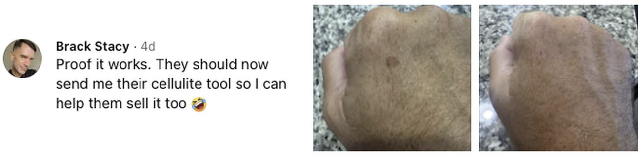 Brack Stacy, verified Facebook comment showing an age spot on the hand before and after