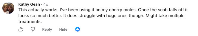 Kathy Gean, verified Facebook comment about treating cherry angiomas