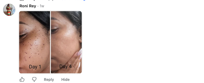 Roni Rey, Facebook comment with day 1 and day 4 before and after photos