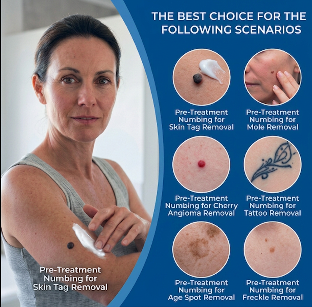 Ocura advanced numbing cream for comfortable spot and skin tag treatment