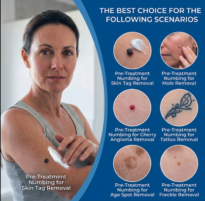 Ocura advanced numbing cream for comfortable spot and skin tag treatment
