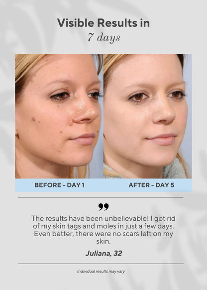 Ocura 6-in-1 plasma pen for removing skin tags, milia and dark bumps at home