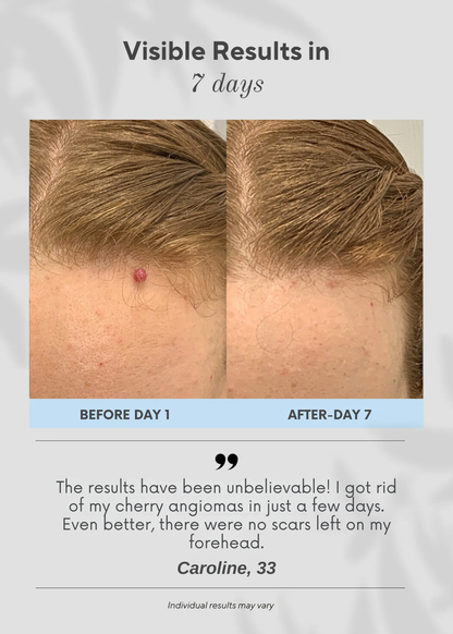 Ocura 6-in-1 cherry angioma removal pen for fading red spots at home