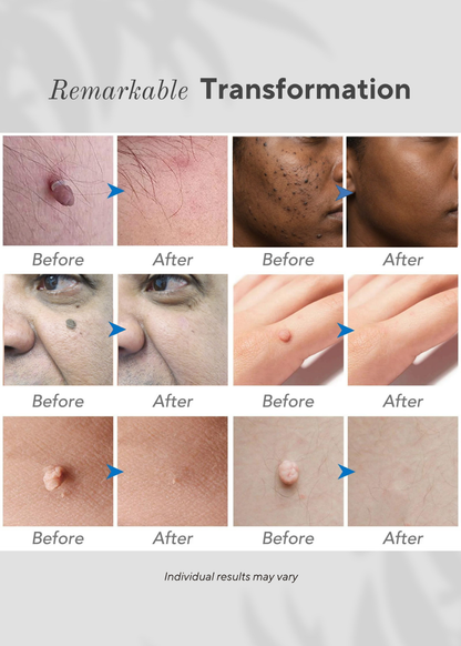 OcuraLife DPN and dark spot removal pen for raised dark bumps