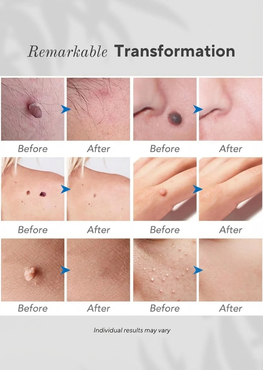Ocura plasma pen for gentle milia and blemish removal
