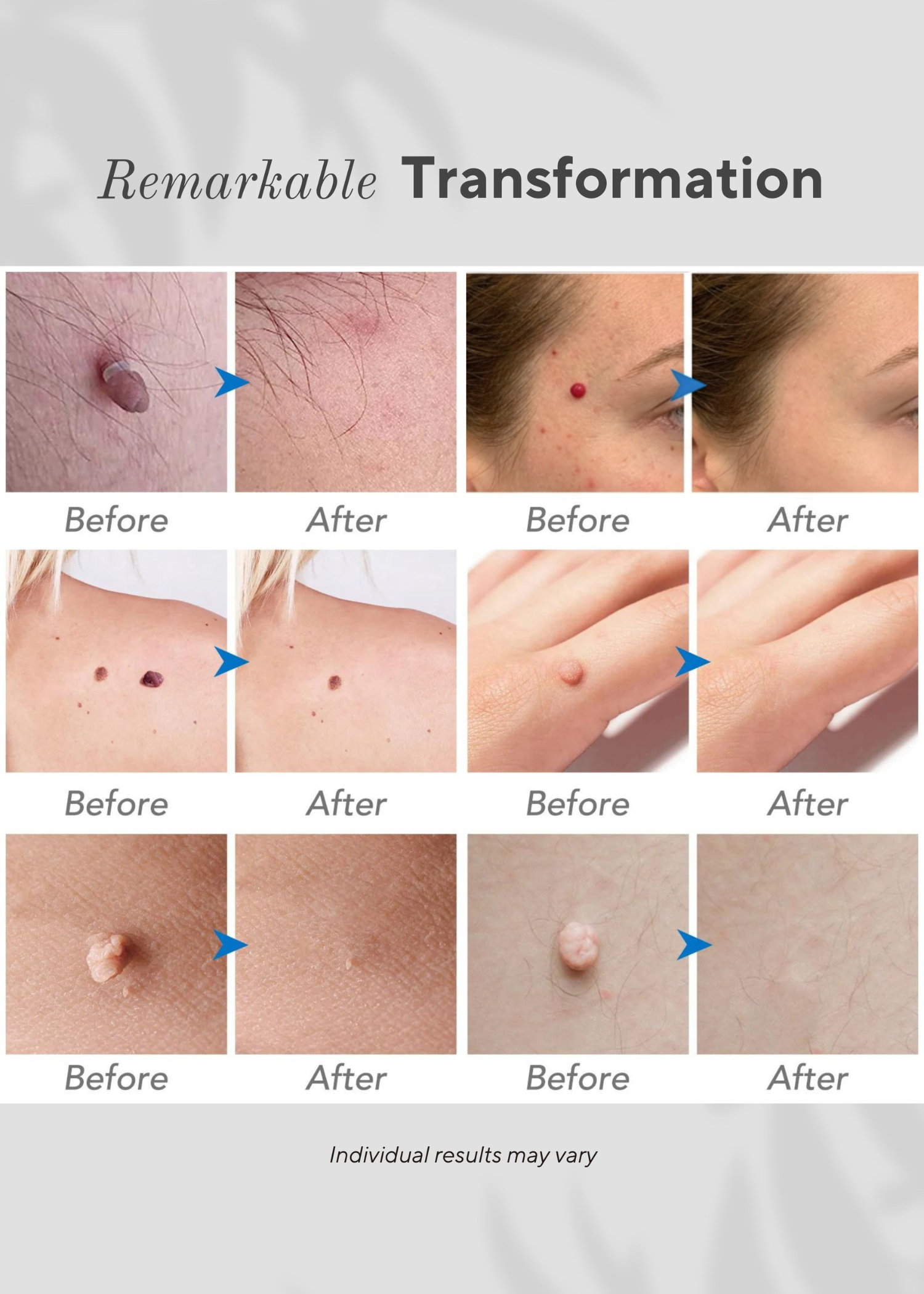 Ocura plasma pen for at-home cherry angioma and red mole removal
