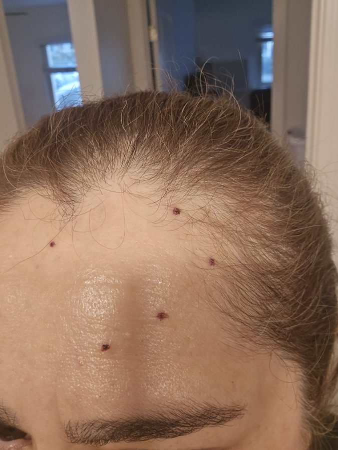 Cherry angiomas on forehead before