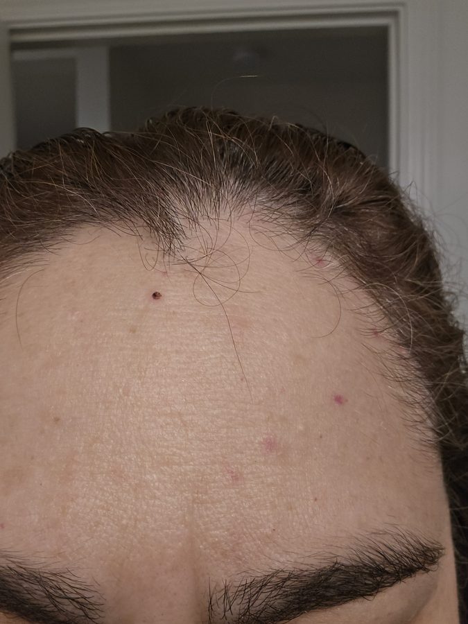 Cherry angiomas on forehead healing