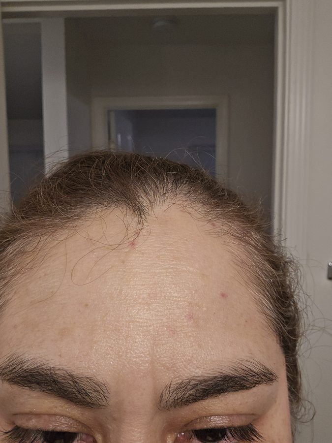 Cherry angiomas on forehead clear after